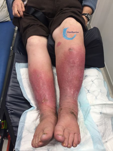 Fichier:Hypodermite chronique48.jpg