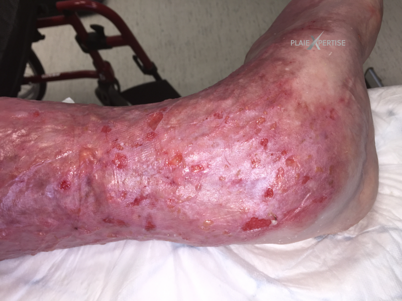 Fichier:Erosion ponctiforme de moins de 5 mm12.png