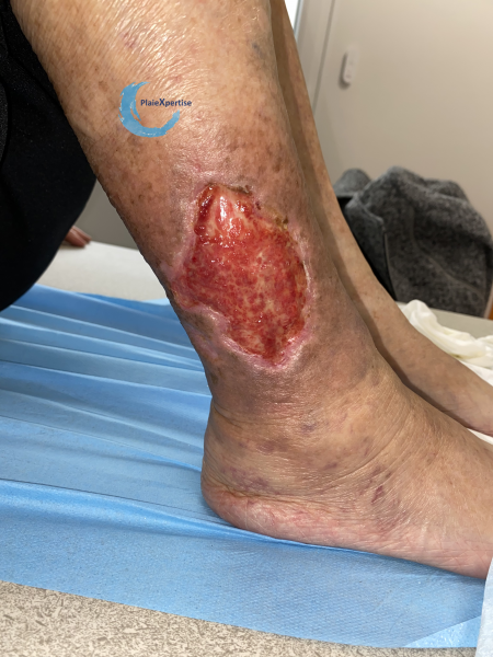 Fichier:Tissu de granulation normal39.png