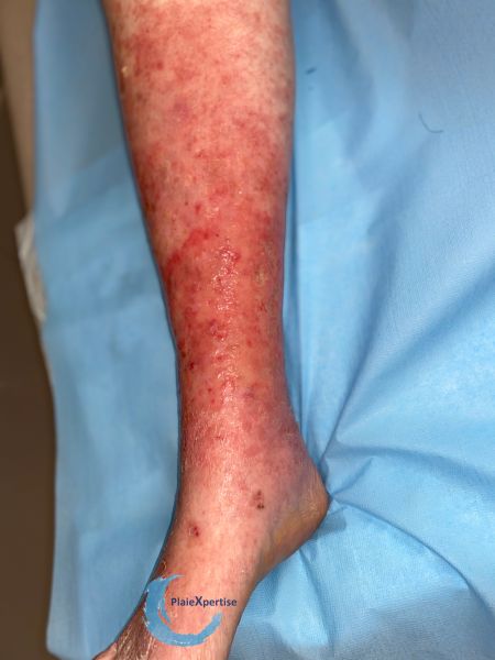 Fichier:Eczéma94.jpg