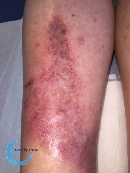 Fichier:Nécrobiose lipoïdique20.jpg