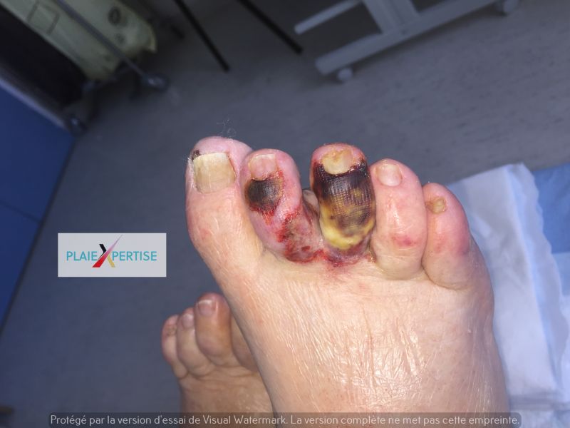 Fichier:Nécrose humide Pied 4.jpg