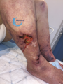 Calciphylaxie5.png