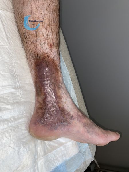 Fichier:Dermite ocre99.jpg