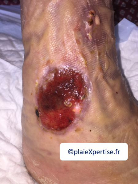 Fichier:Tissu de granulation inflammatoire6.png