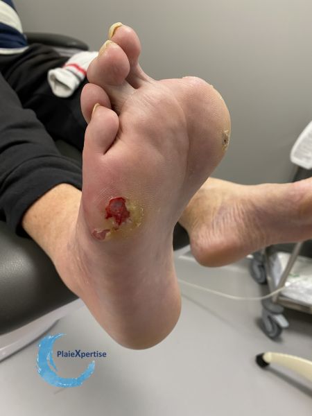 Fichier:Pied de Charcot22.jpg
