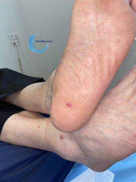Fichier:Porocarcinome1.jpg