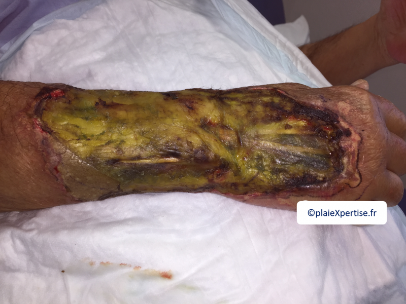 Fichier:Tendon nécrotique humide39.png