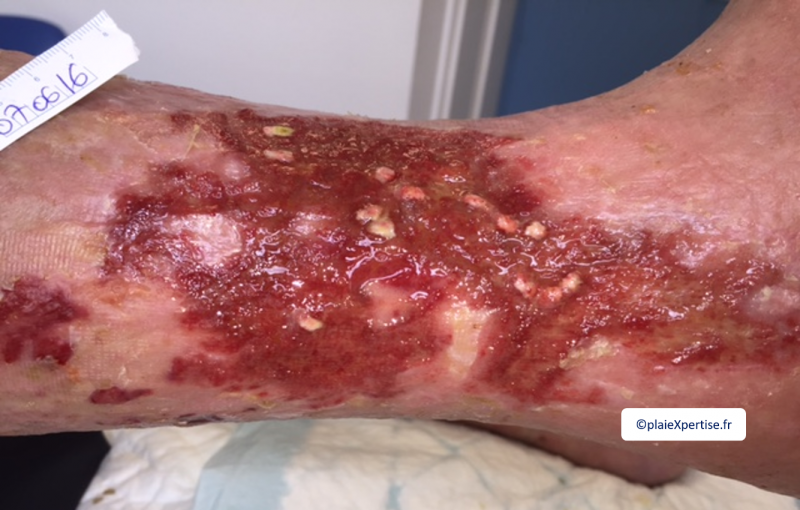Fichier:Tissu de granulation inflammatoire10.png