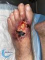 Tendon nécrotique humide78.jpg