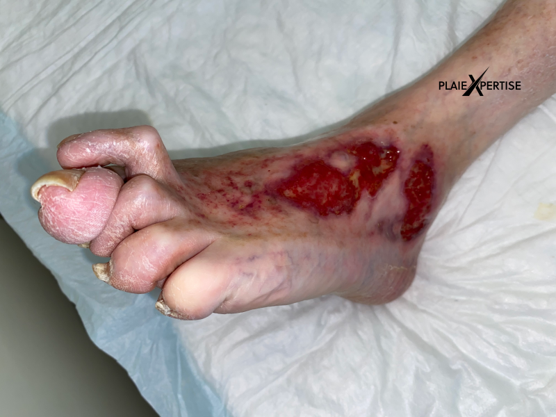 Fichier:Tissu de granulation normal24.png