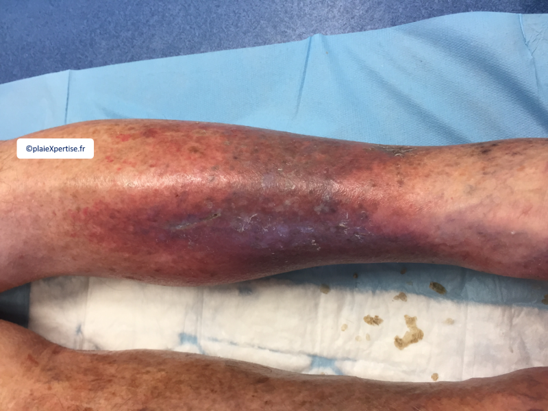 Fichier:Dermiteocre26.png