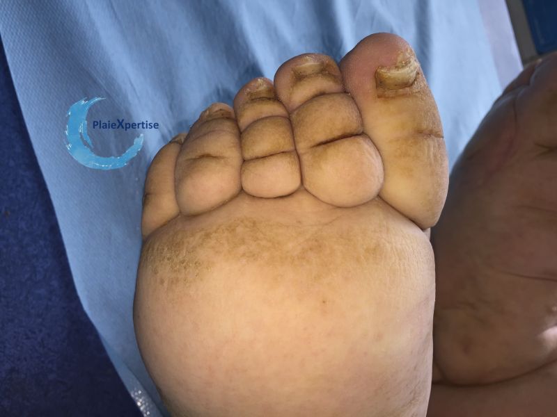 Fichier:Lymphoedème64.jpg