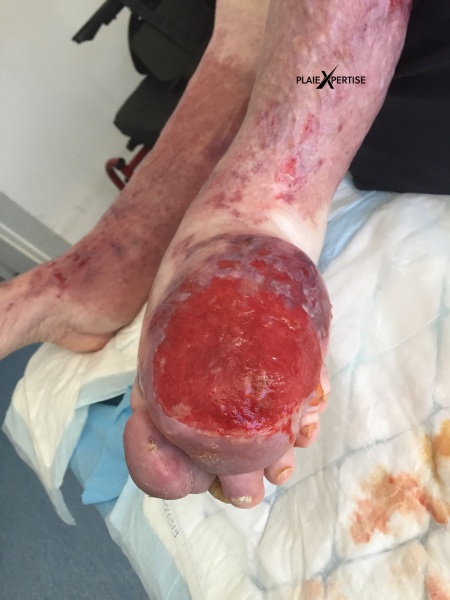 Fichier:Lymphoedème pied16.png