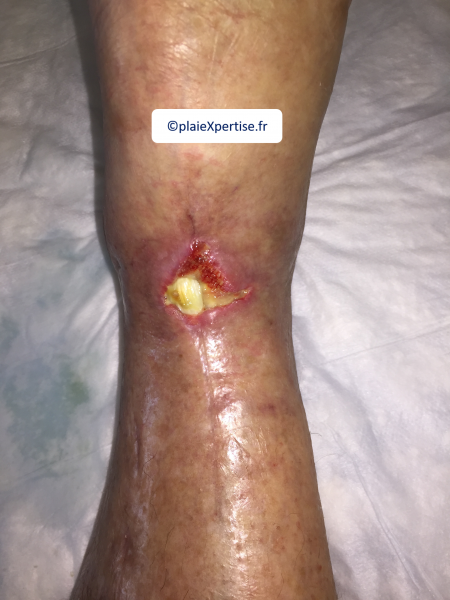 Fichier:Tendon normal16.png