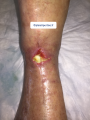 Tendon normal16.png