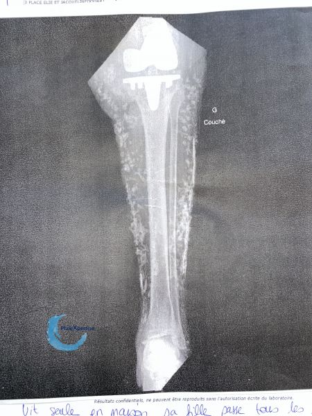 Fichier:Calcifications48.jpg