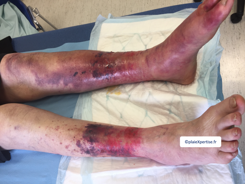 Fichier:Dermatoporose2.png