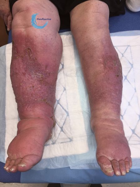 Fichier:Grosses jambes suintantes29.jpg