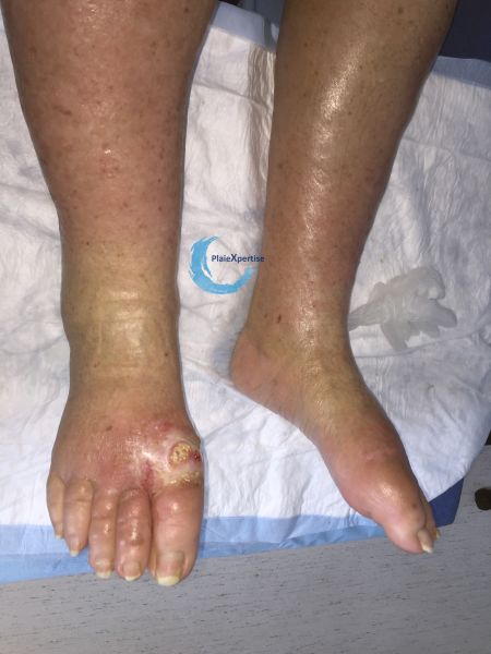 Fichier:Pied goutteux3.jpg