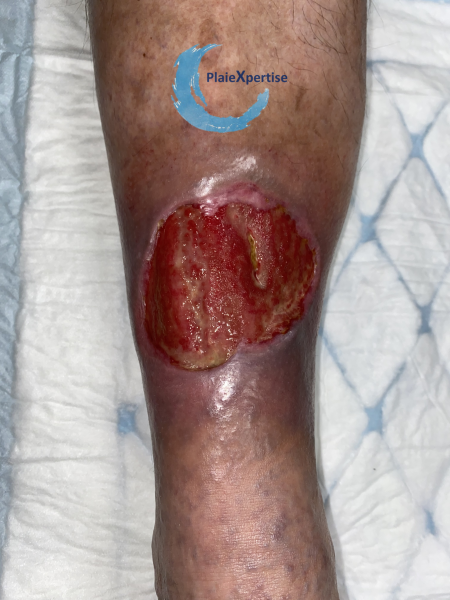 Fichier:Tissu de granulation normal35.png