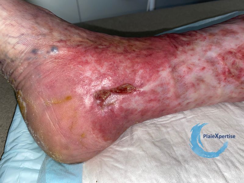 Fichier:Atrophie blanche44.jpg