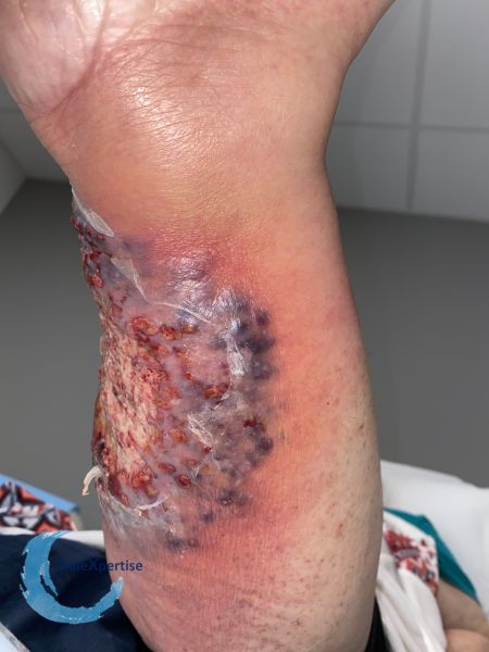 Fichier:Pyoderma gangrenosum43.jpg