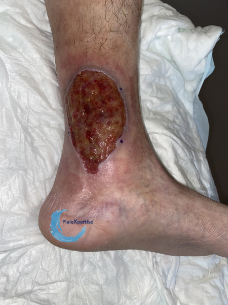 Fichier:Tissu de granulation inflammatoire29.png