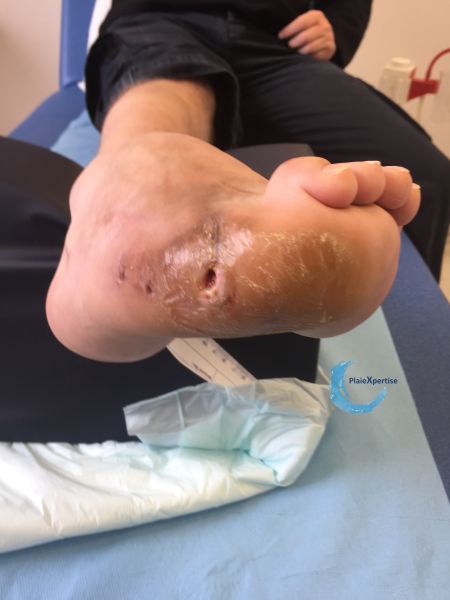 Fichier:Pied de Charcot49.jpg
