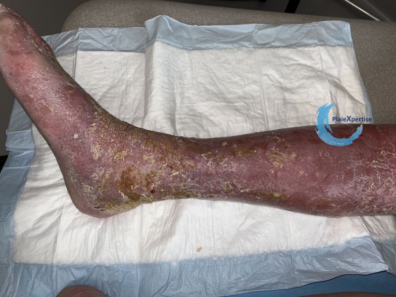 Fichier:Eczéma84.jpg