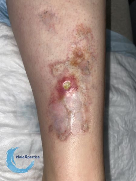 Fichier:Nécrobiose lipoïdique24.jpg