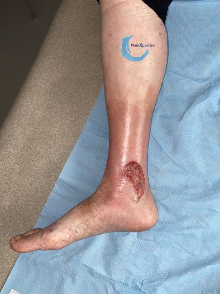 Fichier:Tissu de granulation inflammatoire60.jpg