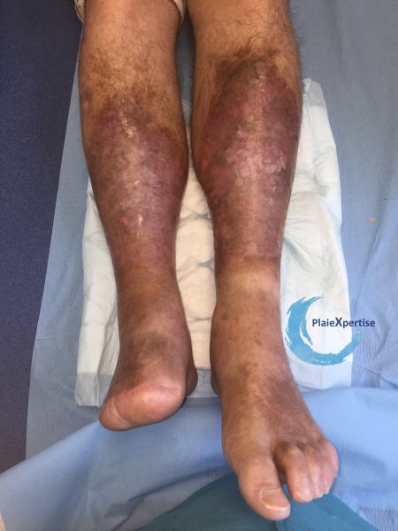 Fichier:Nécrobiose lipoïdique14.jpg