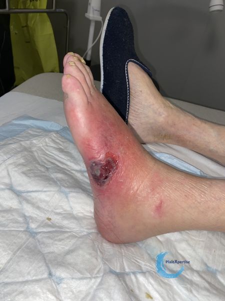 Fichier:Pied infecté48.jpg