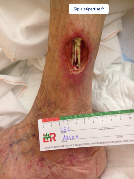 Fichier:Tendon nécrotique humide3.png