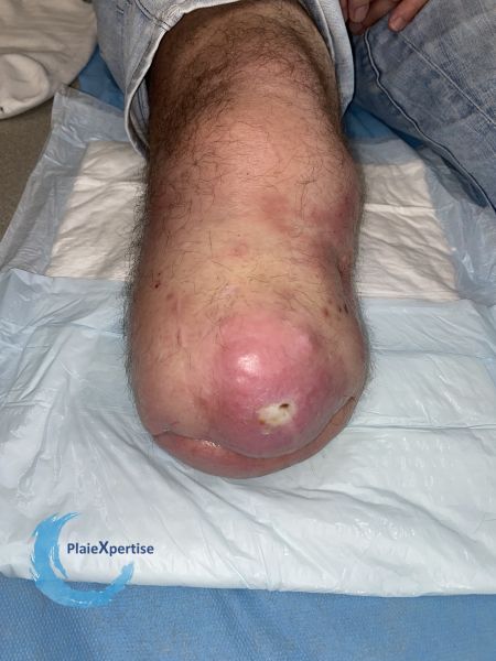 Fichier:Amputation5.jpg