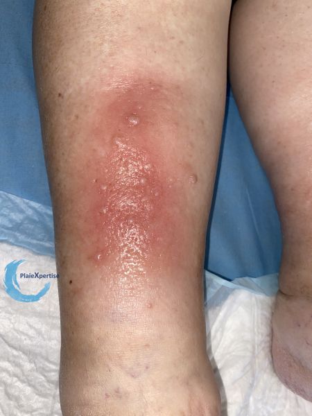 Fichier:Hypodermite chronique67.jpg