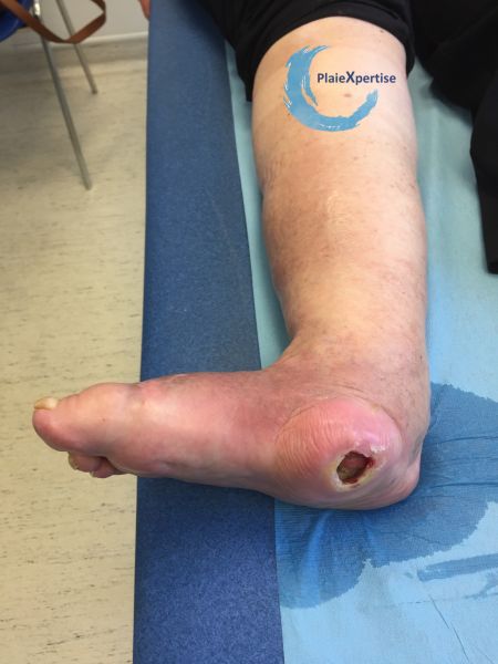 Fichier:Pied de Charcot17.jpg
