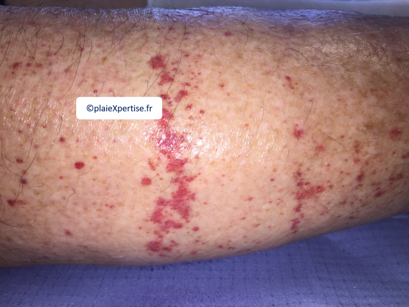 Fichier:Purpura par fragilité capillaire3.png