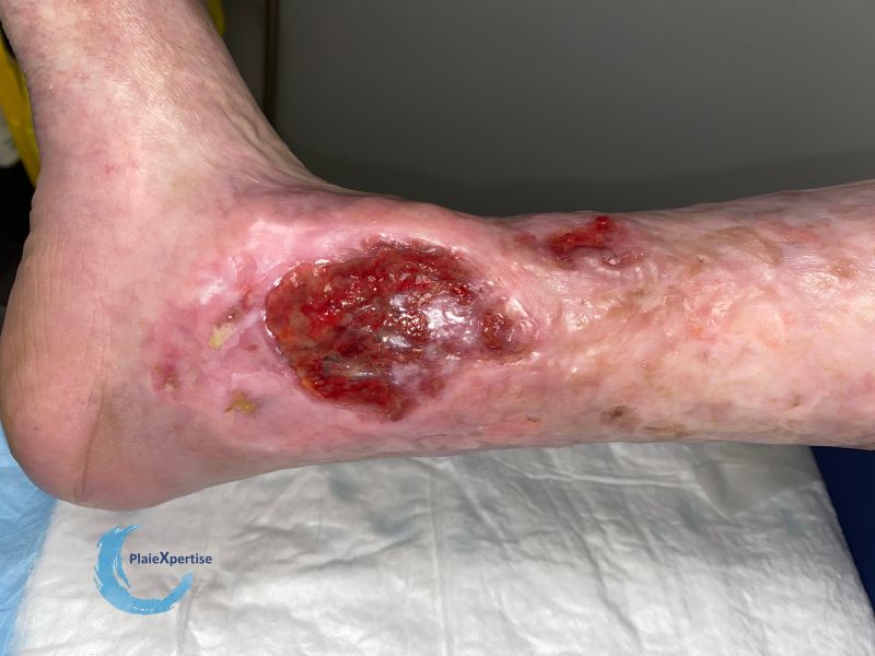 Fichier:Tissu de granulation inflammatoire51.jpg