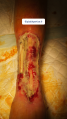 Tendon nécrotique humide1.png