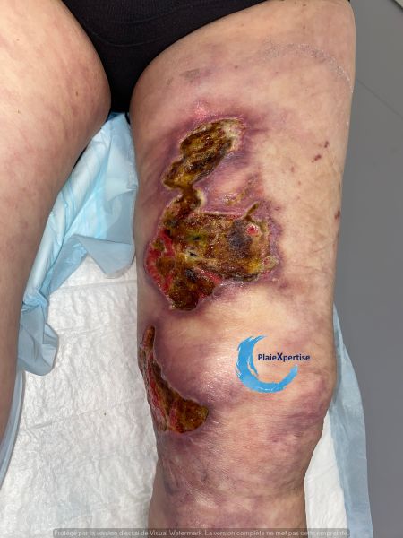 Fichier:Clciphylaxie 24.jpg