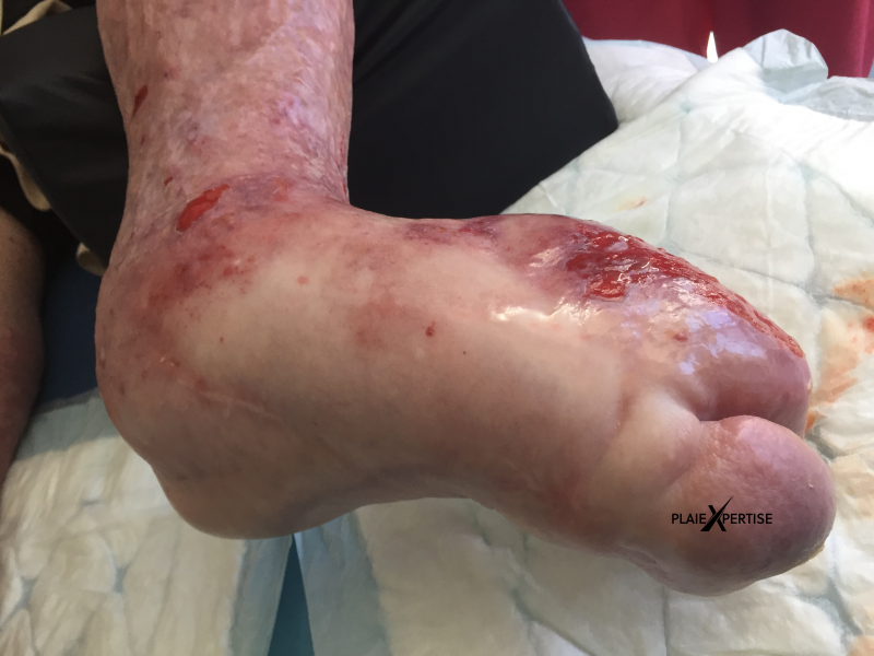 Fichier:Lymphoedème pied19.png