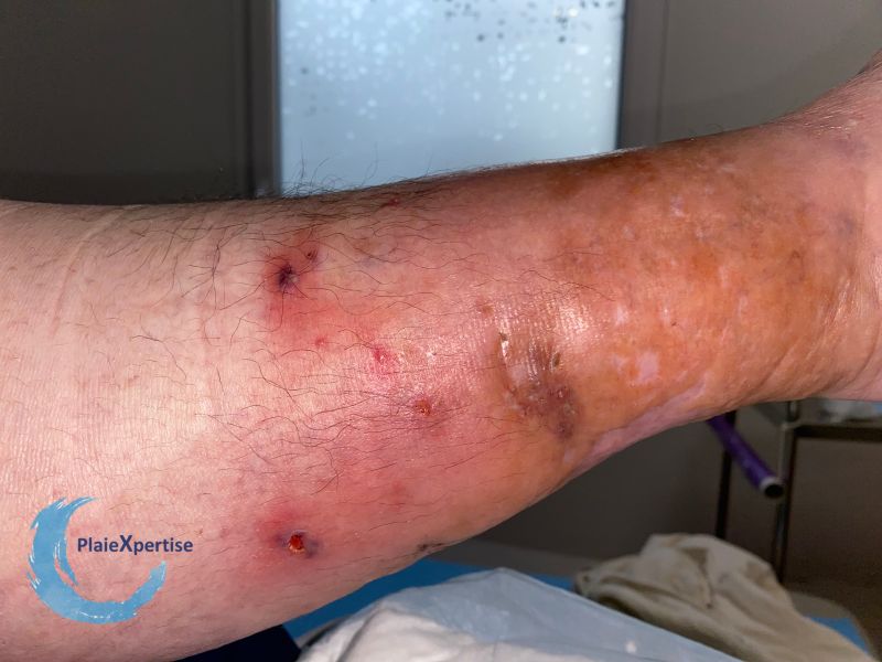 Fichier:Pyoderma gangrenosum55.jpg