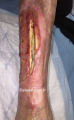 Tendon2.png