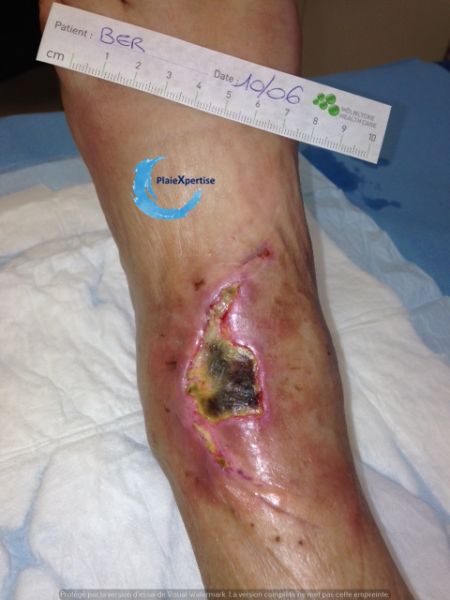 Fichier:Cou de pied104.jpg