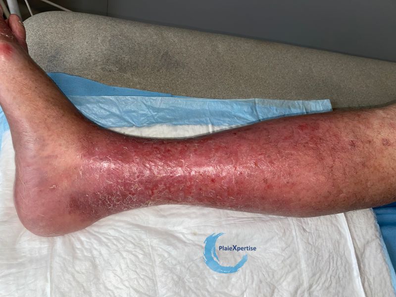 Fichier:Eczéma craquelé32.jpg