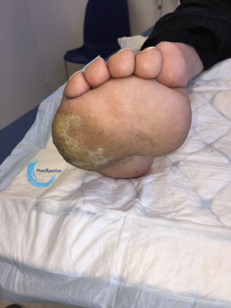 Fichier:Pied de Charcot48.jpg