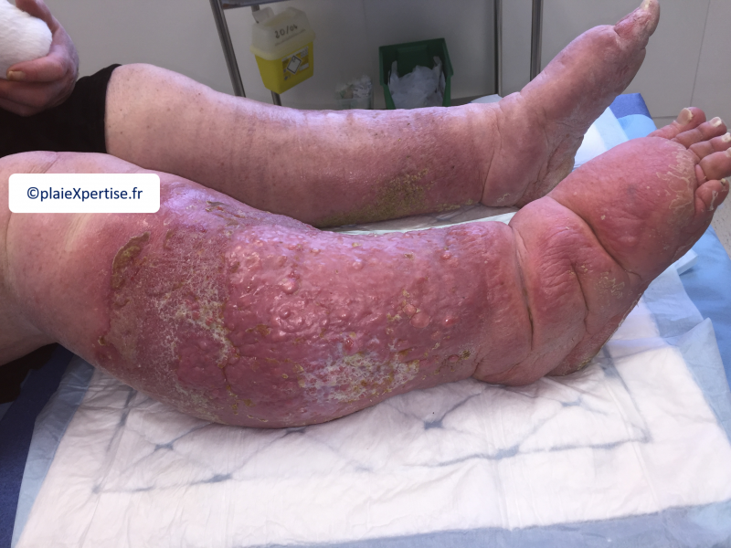 Fichier:Lymphoedème15.png