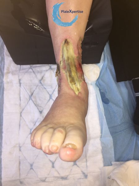 Fichier:Tendon nécrotique humide66.jpg